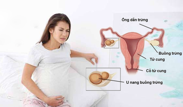 Bị u nang buồng trứng có thể ảnh hưởng đến khả năng mang thai